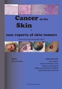 Okładka: Cancer of the Skin - case reports of skin tumors